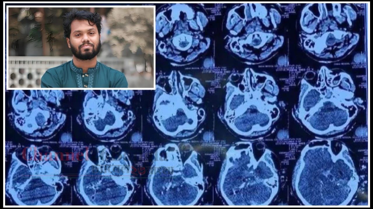 মাথায় প্রবেশ করে বেরিয়ে যাওয়া বুলেট ভয়াবহ ক্ষতি জোড়ালো সমন্বয়ে চলছে চিকিৎসা